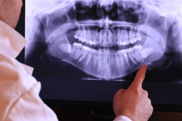Best Emergency Wisdom Teeth Removal in Baldwin, LA